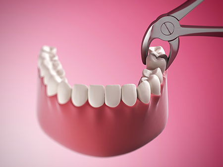 The image shows a close-up of a pair of pliers holding onto a tooth with visible roots, indicating dental work or extraction is being performed.